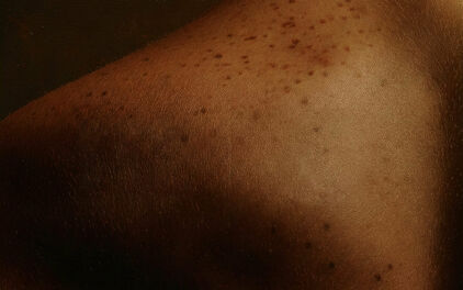 Brun hud med fräknar på någons axel.